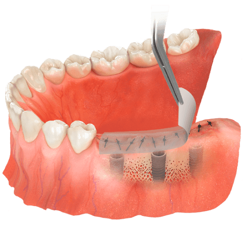 ora-aid-aposito-intraoral-curacion